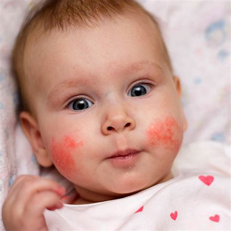 bebeklerde süt alerjisi nasıl geçer
